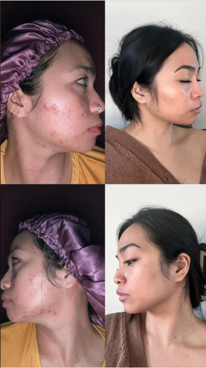 The 30-Day Cystic Acne Reset: The Correct Approach